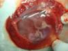 foetus in the amniotic aac